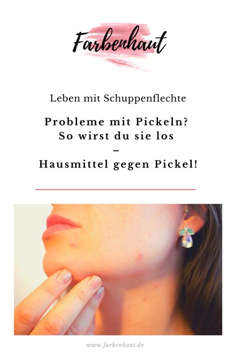 Die besten methoden im überblick. Probleme mit Pickeln? So wirst du sie los - Hausmittel ...