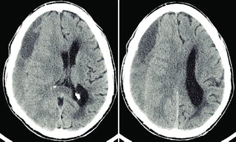 Preoperative Cranial Ct Scan Images Of The First Patient Showing Right