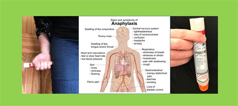 Anaphylaxis Andersson First Aid Training