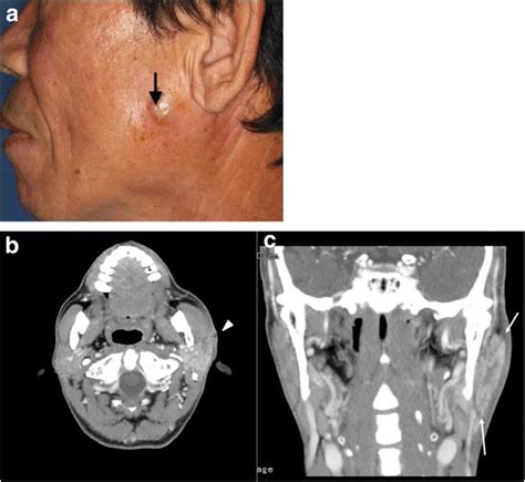 Facelift Incision And Superficial Musculoaponeurotic System Advancement