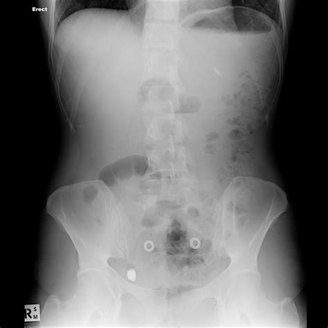 Pill Cam Related Small Bowel Perforation Radiology Case