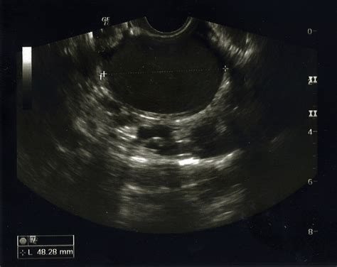 What Is A Fallopian Tube Ultrasound Two Views
