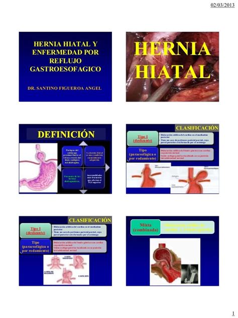 Hernia Hiatal Esofagitis Y Erge