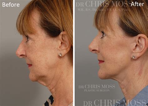 Facelift And Neck Lift Results Before And After