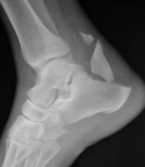 Calcaneal Tuberosity Avulsion Fracture An Unusual Variant The