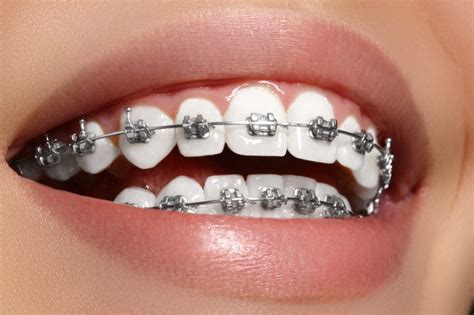 How Much Do Braces Cost Central Coast Orthodontics