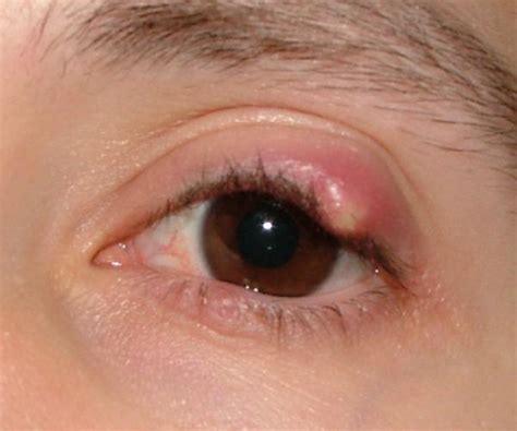 Eyelid Red And Swollen Eyelids