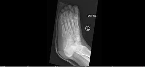 Lisfranc Orif — Chicago Foot And Ankle Orthopaedic Surgeons