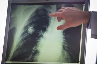 Laryngeal cancer treatment depends upon the exact location and extent of disease and can include radiation therapy, surgery, and chemotherapy. Low-Dose CT (LDCT) Screening for Lung Cancer - Abramson ...