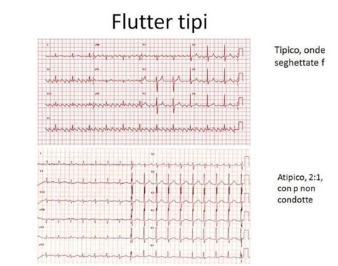 Flutter Atriale Cause Sintomi E Terapia Blog Sulla Salute Del Cuore