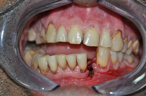 Mandibular Jaw Fracture