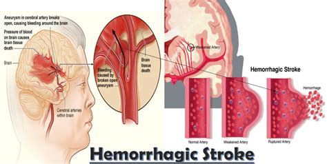 Intracerebral Hemorrhage Causes Symptoms Diagnosis Treatment Recovery