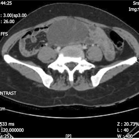 Abdominopelvic Computed Tomography Ct Sagittal With Intravenous And