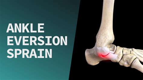 Ankle Eversion Sprain Youtube