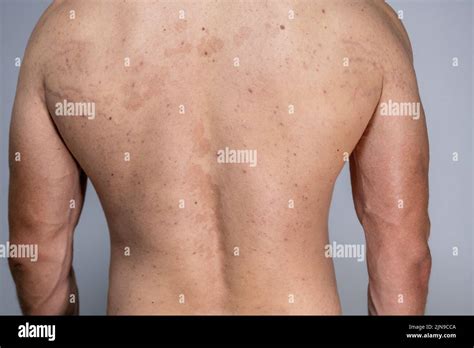 Tinea Versicolor On The Back Pityriasis Versicolor Problem With Skin