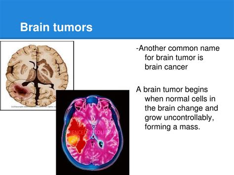 Ppt Brain Tumors Powerpoint Presentation Free Download Id3923651