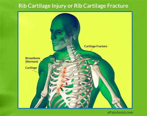Rib Cartilage Injury Treatmentcausessymptomsdiagnosis