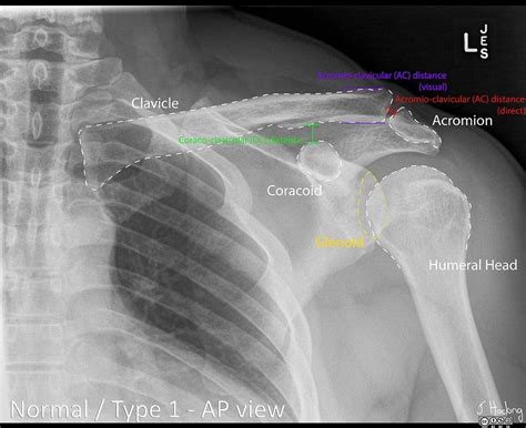 An X Ray Shows The Location Of The Shoulder In This Image And Where It Is