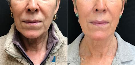 Nonsurgical Natural Facelift With Hyperdilute Radiesse Sofwave Voluma