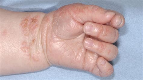 Dermatite E Eczema Em Crianças Babycenter