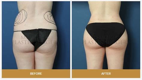 Brazilian Butt Lift Before And After MemorialPlasticSurgery Plastic