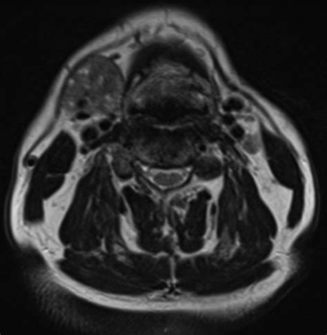 Bilateral Submandibular Gland Nodular Oncocytic Hyperplasia With