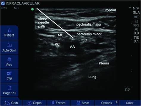 Ultrasound Guided Infraclavicular Brachial Plexus Block Anesthesia Key