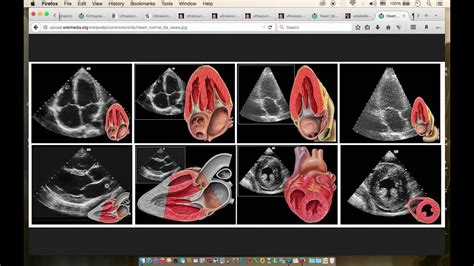 Basics Of Echocardiography Youtube