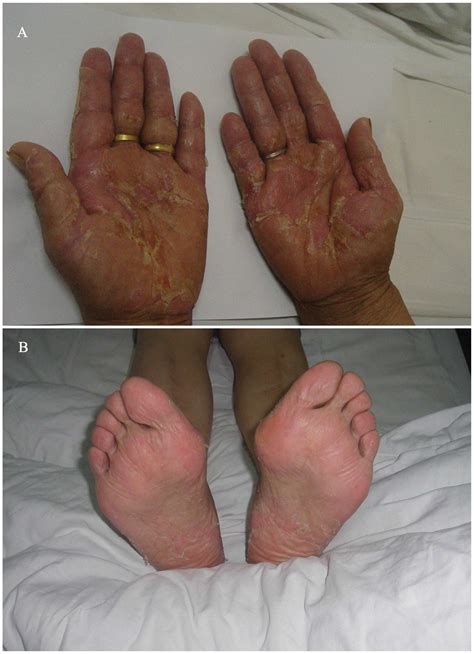 Hand Foot Syndrome In A Patient With Metastatic Lung Adenocarcinoma