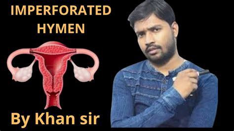Imperforated Hymen Perforated Hymen Hymen Exam Virgin Hymen Hymen Youtube