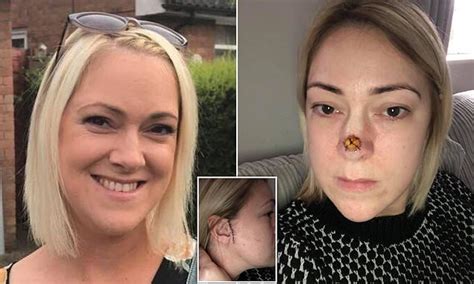 Woman Found Spot On End Of Her Nose Was Actually Cancer Daily Mail