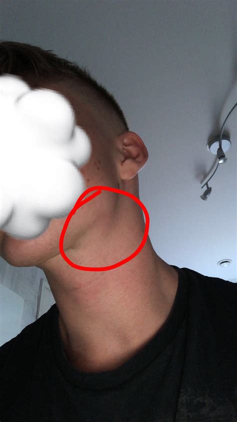 Swollen Lump Lymph Node Under Jaw Makes Jawline On One Side Look Bad