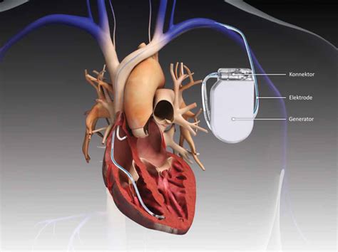 Herzschrittmacher Aufbau Und Funktion