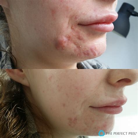 Chemical Peels For Acne Acne Treatment The Perfect Peel