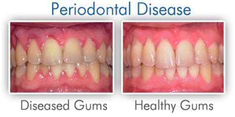 Gum Disease Gingivitis Periodontitis Symptom And Treatment Preston
