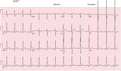 A 12 Lead Ecg Showed 2 Mm St Elevation In Leads Ii Iii And Avf With
