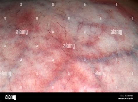 Skin Tissue Cancerous Cells Hi Res Stock Photography And Images Alamy