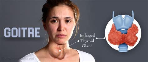 Goitre Thyroid Swelling Types Causes Symptoms Diagnosis