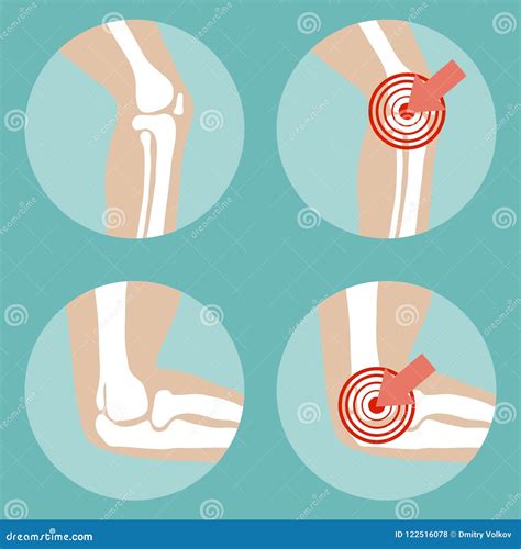 Knee And Elbow Joints Rights Patient And Healthy Joints Stock