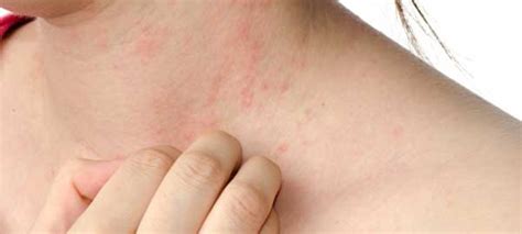 Eczema Skin Irritations And Children Dr Rachel Hamel Wholistic