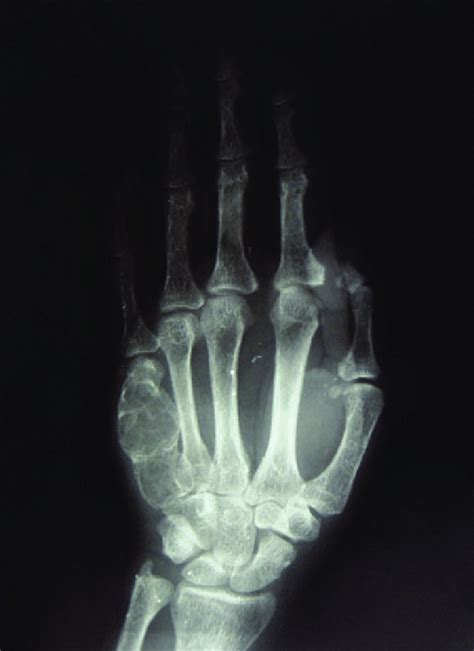 Hand Radiograph Showing Subperiosteal Bone Resorption At The Radial