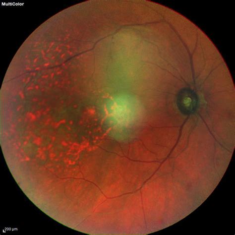 Peripheral Retinal Pathology Including Lattice Degeneration