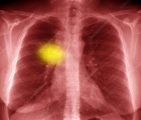 Lung Cancer Coloured X Ray Stock Image C0529814 Science Photo