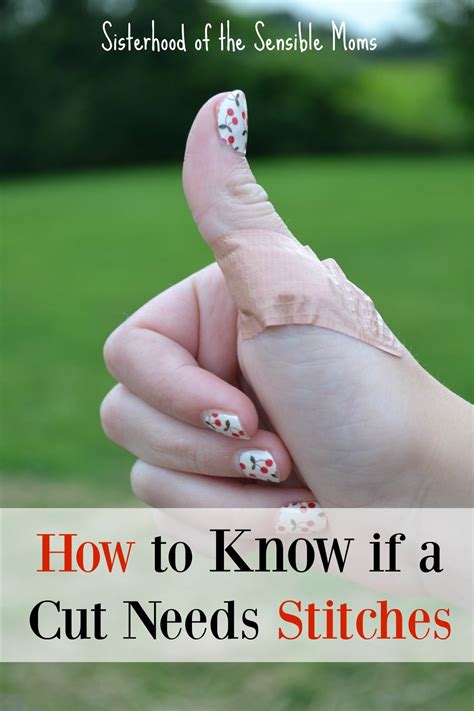How To Know If A Cut Needs Stitches Sisterhood Of The Sensible Moms