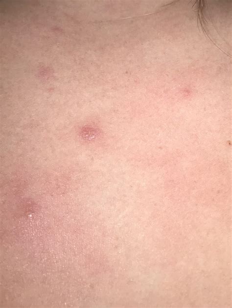 Skin Concerns Red Unpoppable Itchy Bumps On Rashy Chest Probably