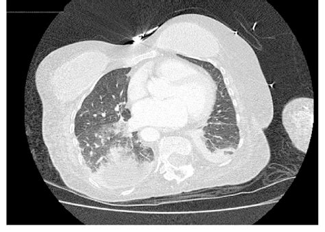Axial Ct Scan Of The Chest Showing A View In Arterial Phase With Lung