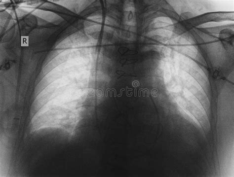 X Ray Image Of Patient After Cardiac Surgery Stock Image Image Of