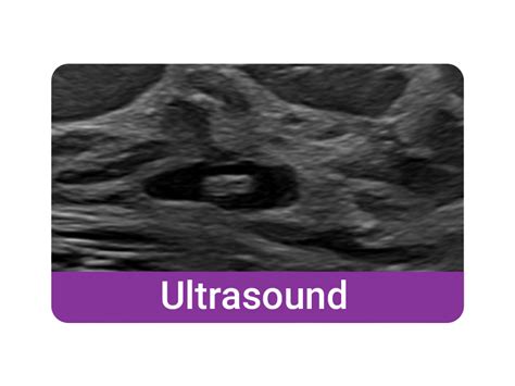 Hydromark™ Breast Biopsy Site Marker