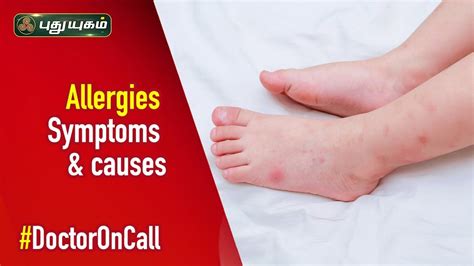 What Are The Common Causes Of Skin Allergies Doctor On Call 1412