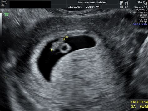 Pregnancy 5 Weeks 5 Days Ultrasound Pregnancywalls
